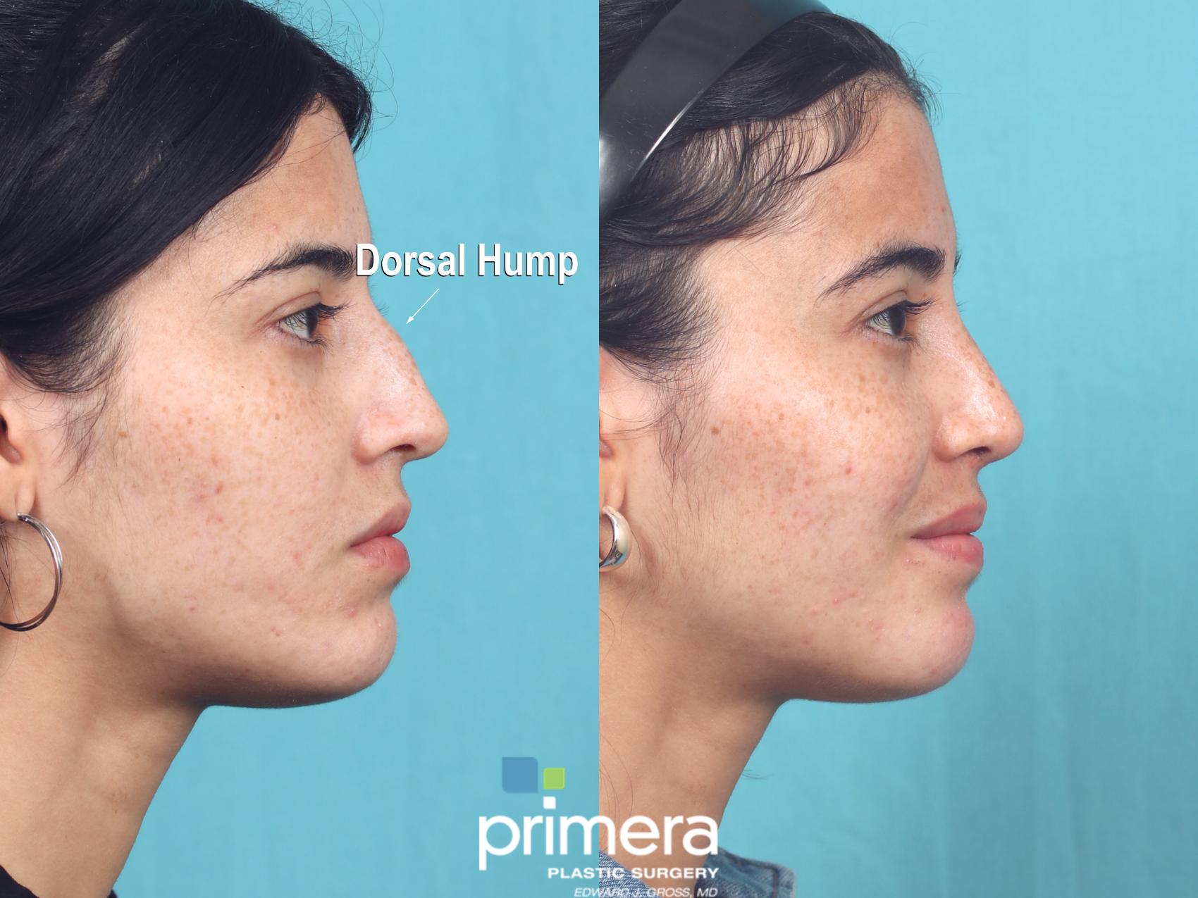 Before & After Rhinoplasty Case 935 Right Side View in Orlando, Florida