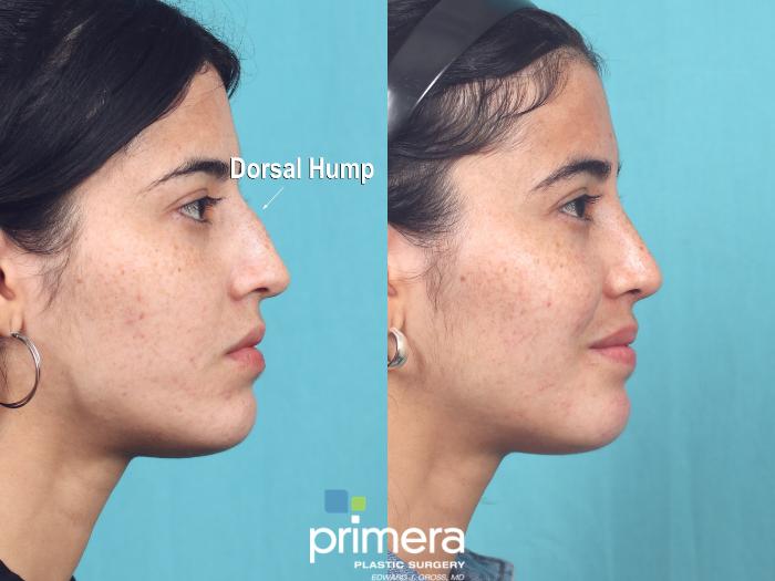 Before & After Rhinoplasty Case 935 Right Side View in Orlando, Florida