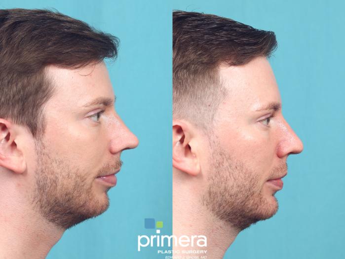 Before & After Chin & Cheek Implant Case 937 Right Side View in Orlando, Florida