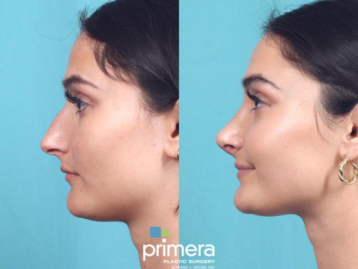 Before & After Rhinoplasty Case 940 Left Oblique View in Orlando, Florida
