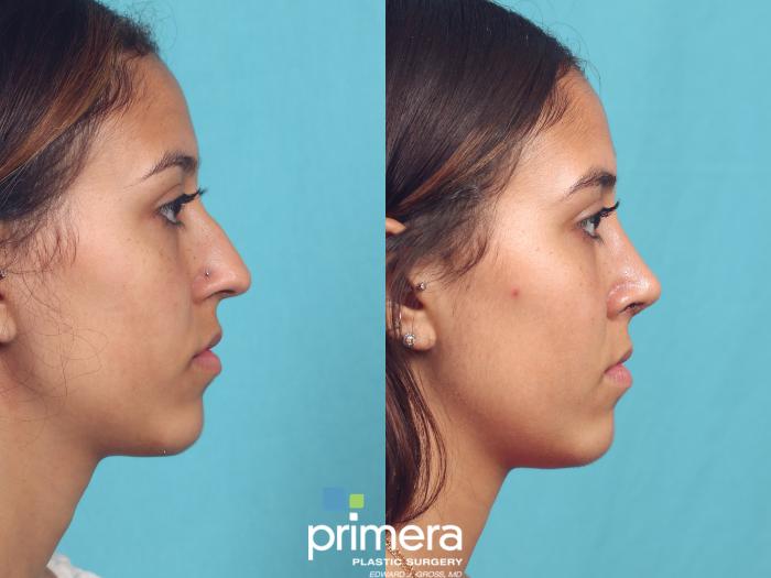 Before & After Rhinoplasty Case 943 Right Side View in Orlando, Florida