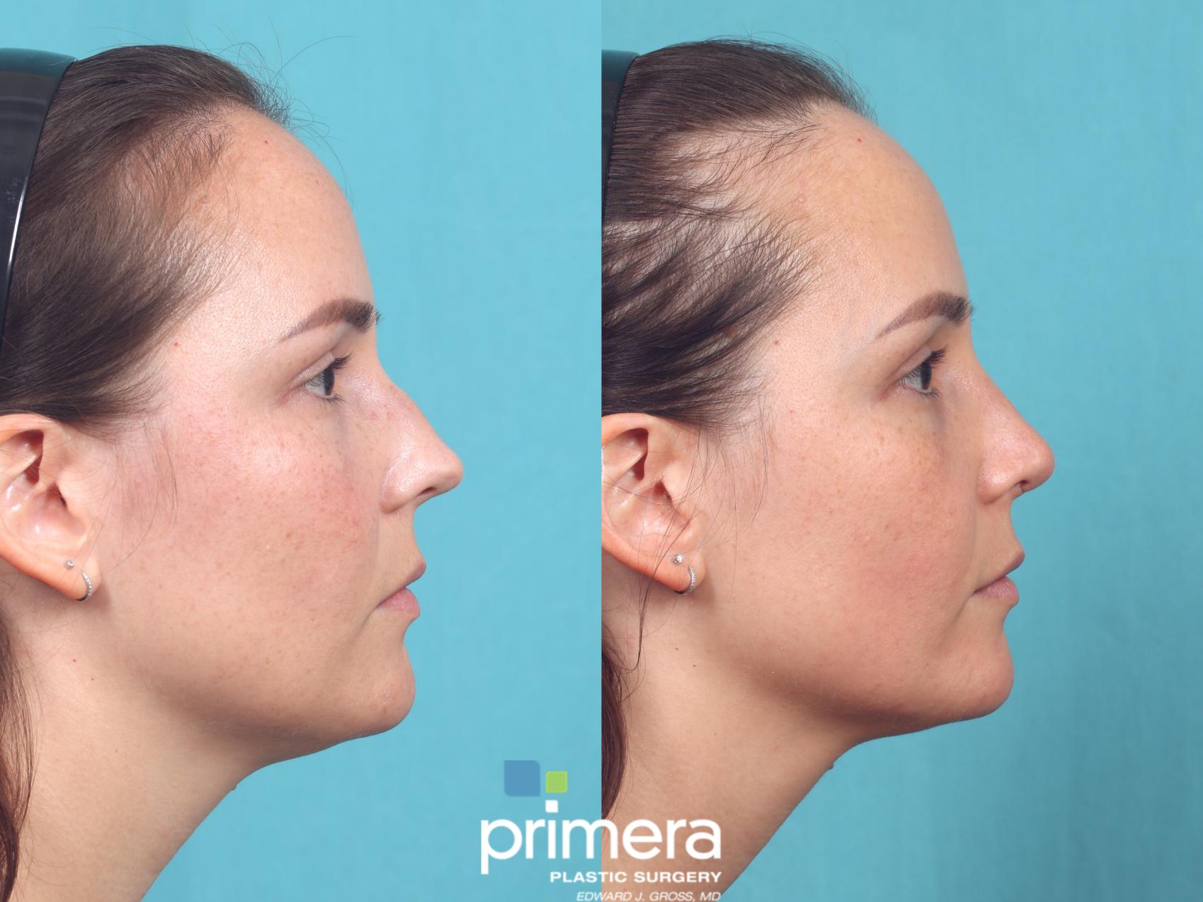 Before & After Rhinoplasty Case 944 Right Side View in Orlando, Florida