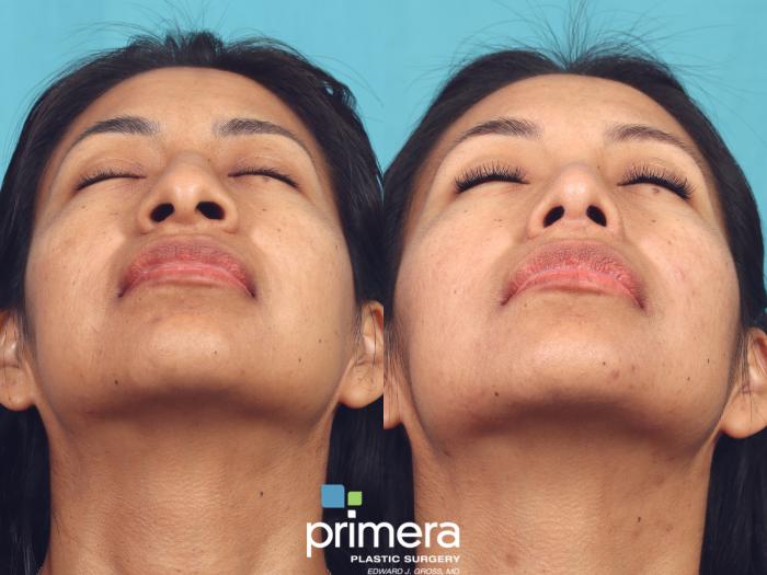 Before & After Rhinoplasty Case 949 Base View View in Orlando, Florida
