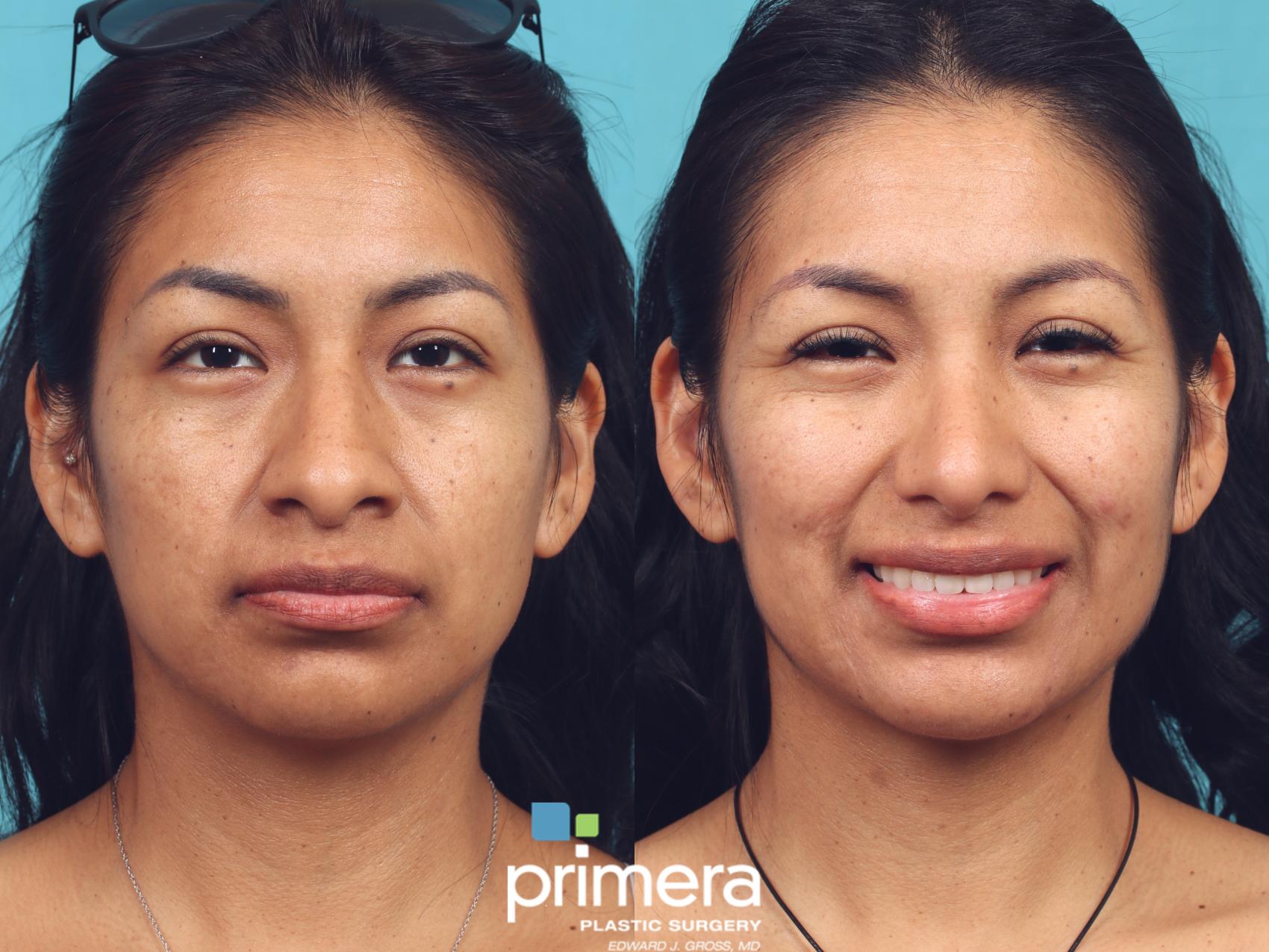 Before & After Rhinoplasty Case 949 Front View in Orlando, Florida