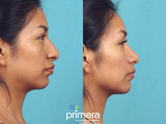 Before & After Rhinoplasty Case 949 Right Side View in Orlando, Florida