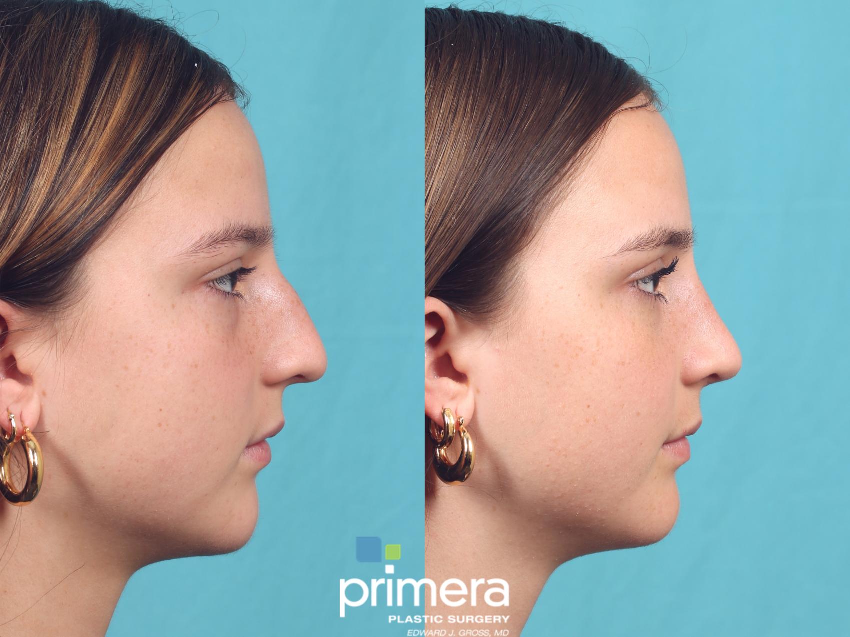 Before & After Rhinoplasty Case 951 Right Side View in Orlando, Florida