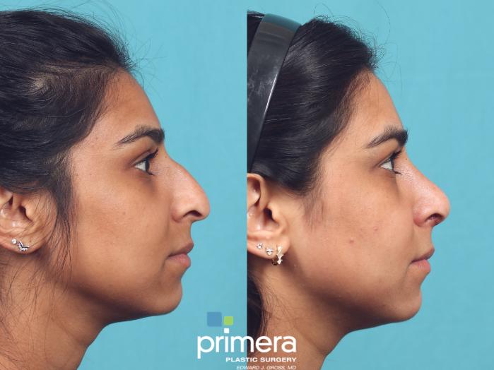 Before & After Rhinoplasty Case 955 Right Side View in Orlando, Florida