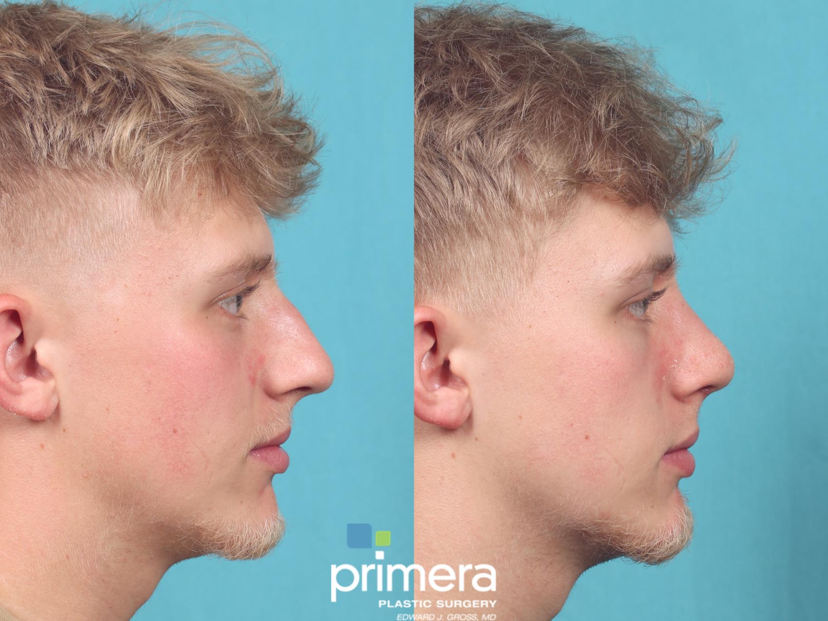 Before & After Rhinoplasty Case 956 Right Side View in Orlando, Florida