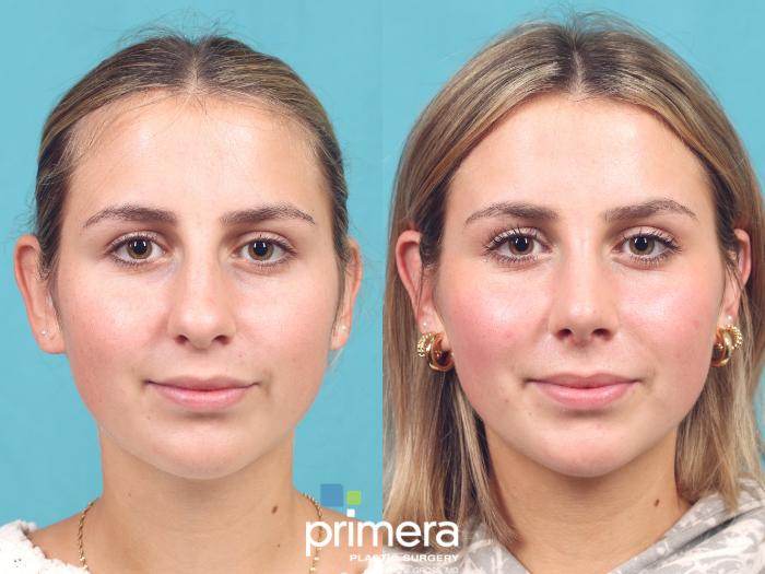 Before & After Rhinoplasty Case 963 Front View in Orlando, Florida