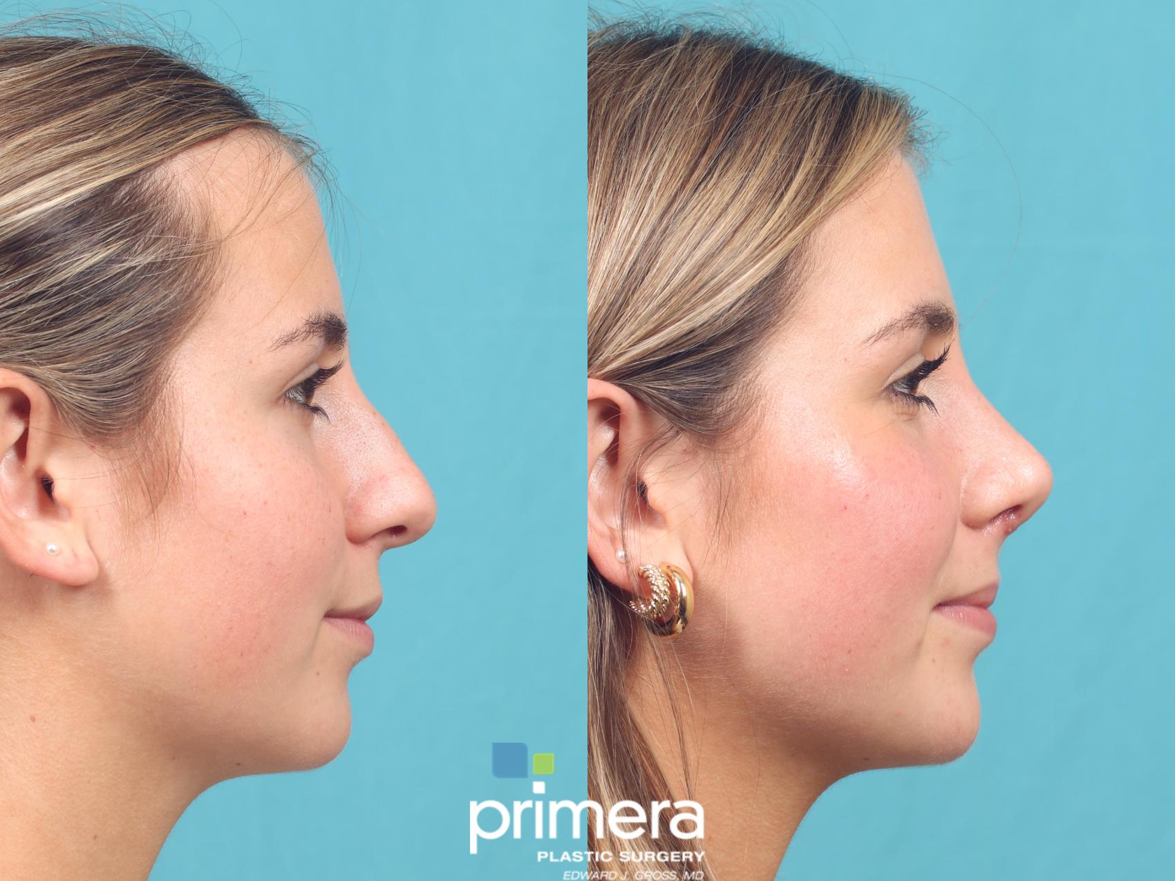 Before & After Rhinoplasty Case 963 Right Side View in Orlando, Florida