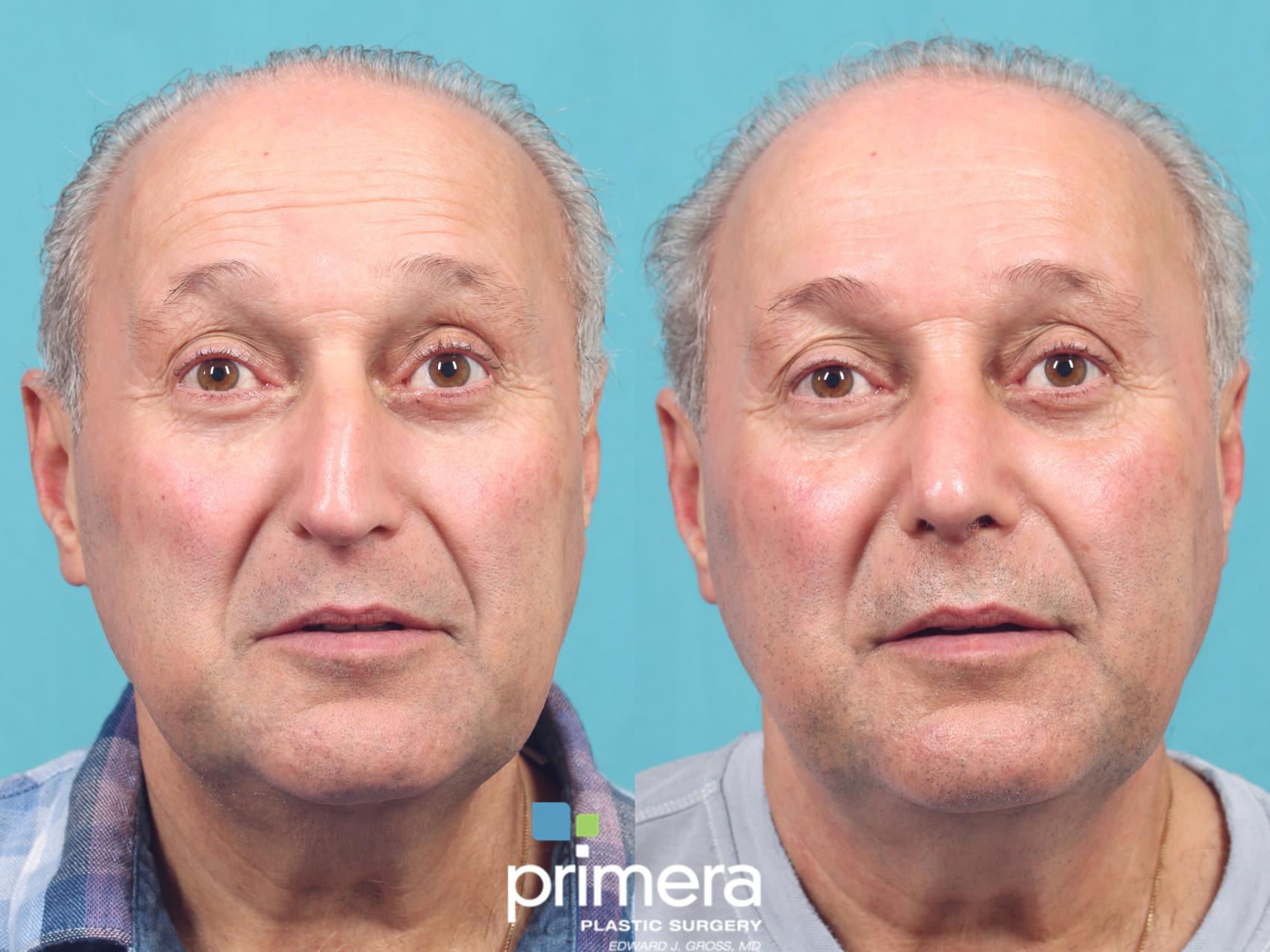 Before & After Revision Rhinoplasty Case 964 Front View in Orlando, Florida