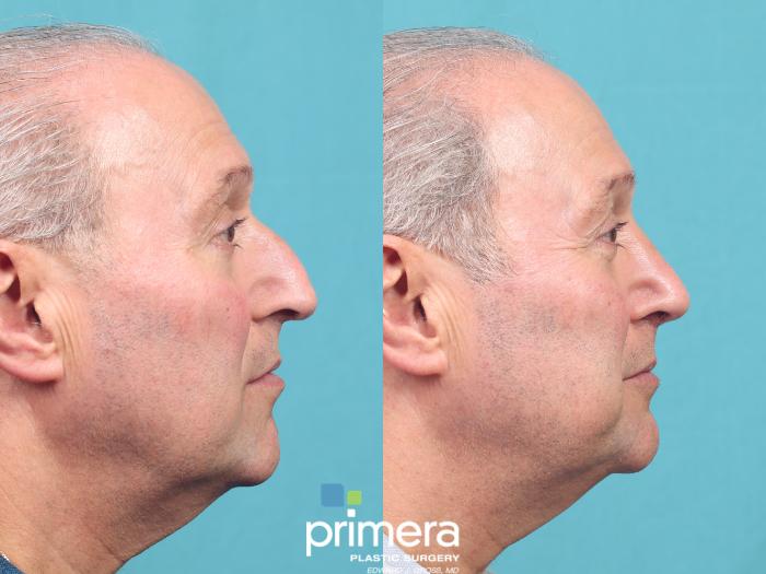 Before & After Revision Rhinoplasty Case 964 Right Side View in Orlando, Florida