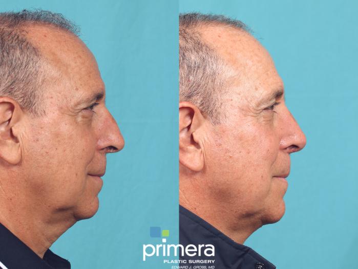 Before & After Rhinoplasty Case 966 Right Side View in Orlando, Florida