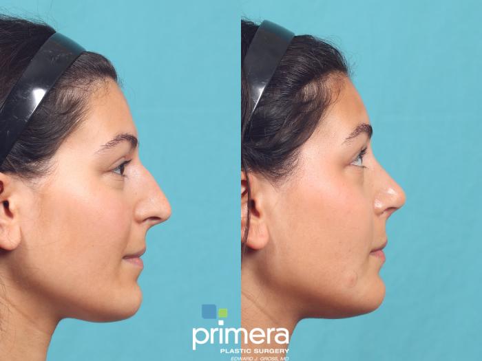 Before & After Rhinoplasty Case 977 Right Side View in Orlando, Florida