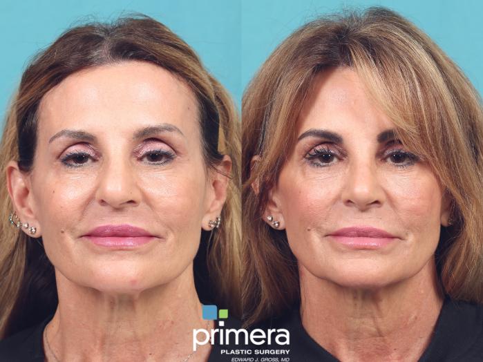 Before & After Rhinoplasty Case 984 Front View in Orlando, Florida