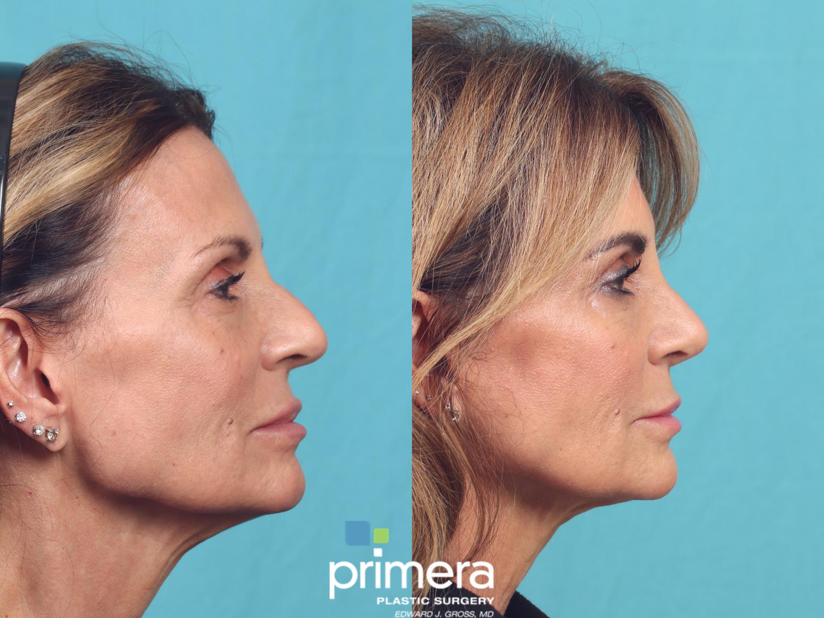 Before & After Rhinoplasty Case 984 Right Side View in Orlando, Florida