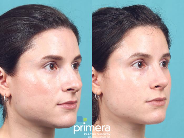 Before & After Rhinoplasty Case 987 Right Oblique View in Orlando, Florida