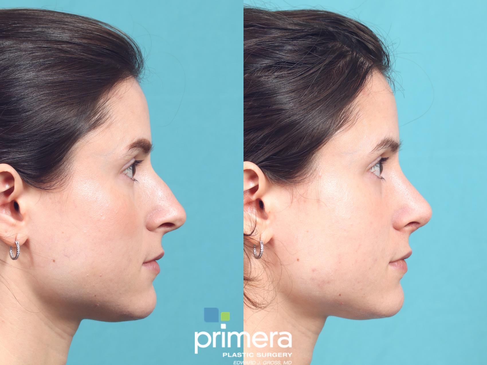 Before & After Rhinoplasty Case 987 Right Side View in Orlando, Winter Park & Tampa, Florida