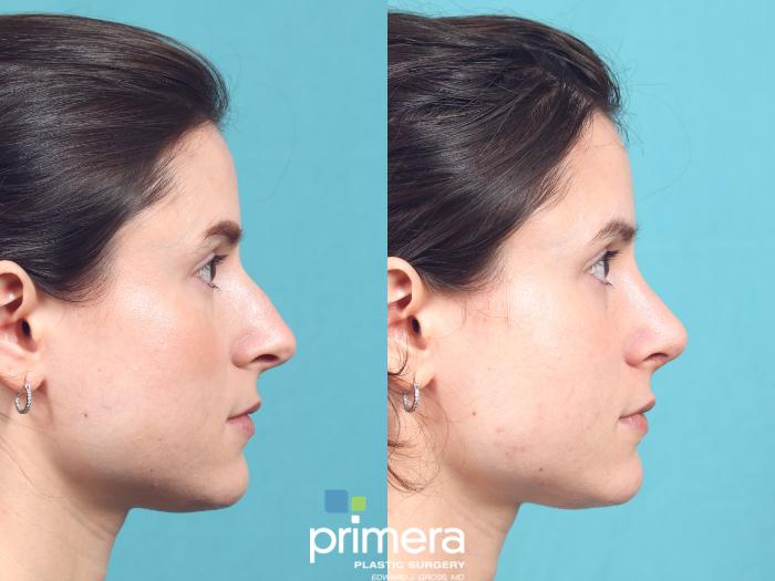 Before & After Rhinoplasty Case 987 Right Side View in Orlando, Florida