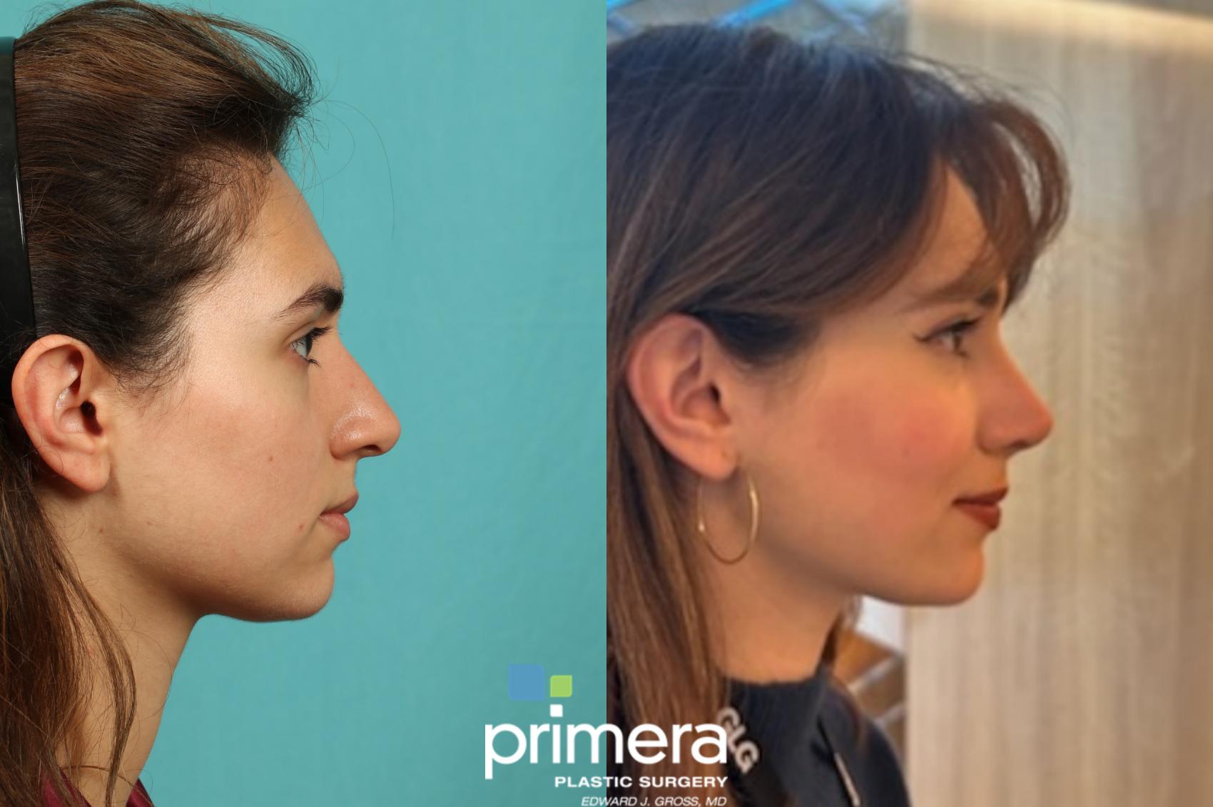 Before & After Rhinoplasty Case 988 Right Side View in Orlando, Florida