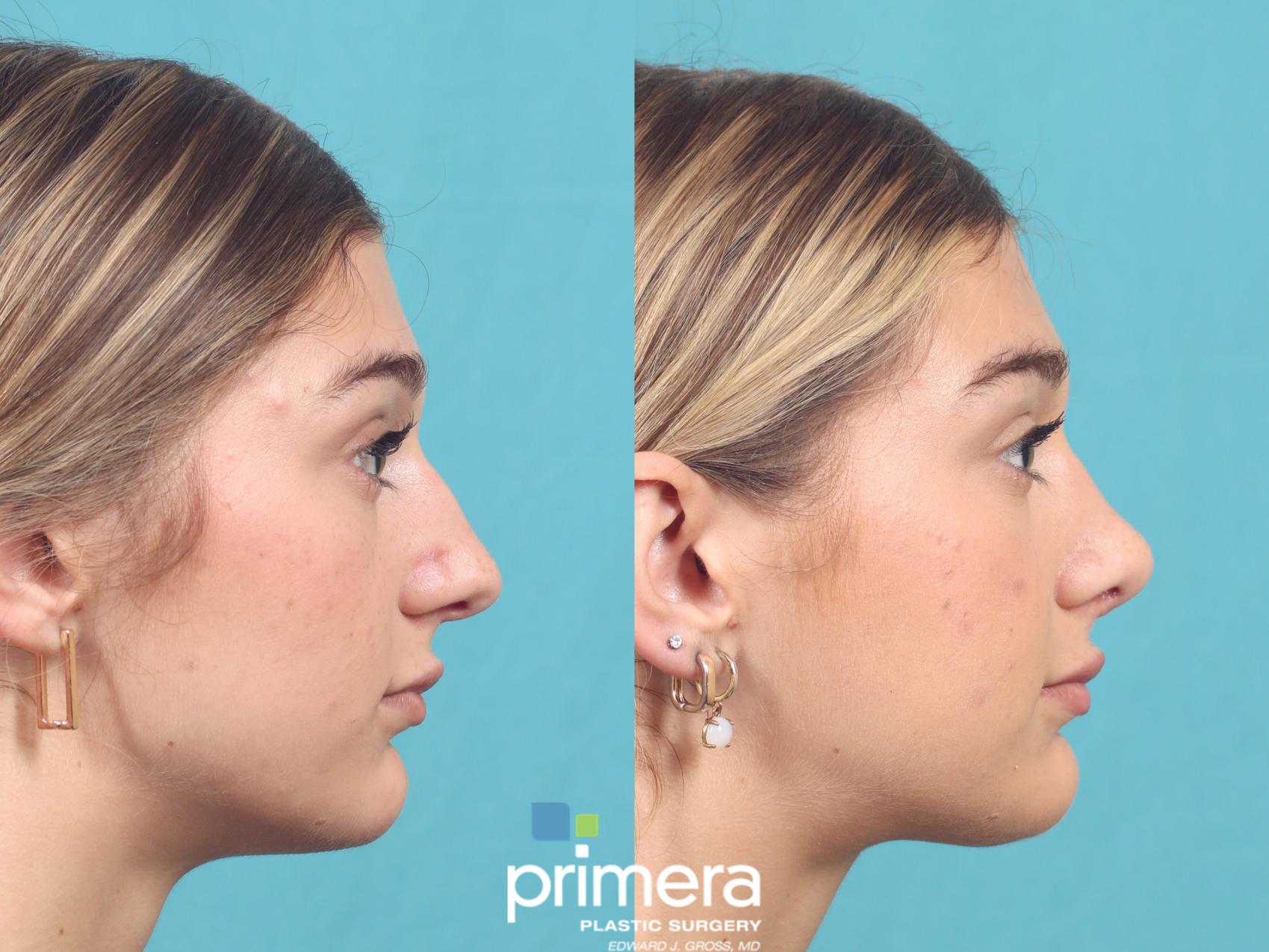 Before & After Rhinoplasty Case 990 Right Side View in Orlando, Florida