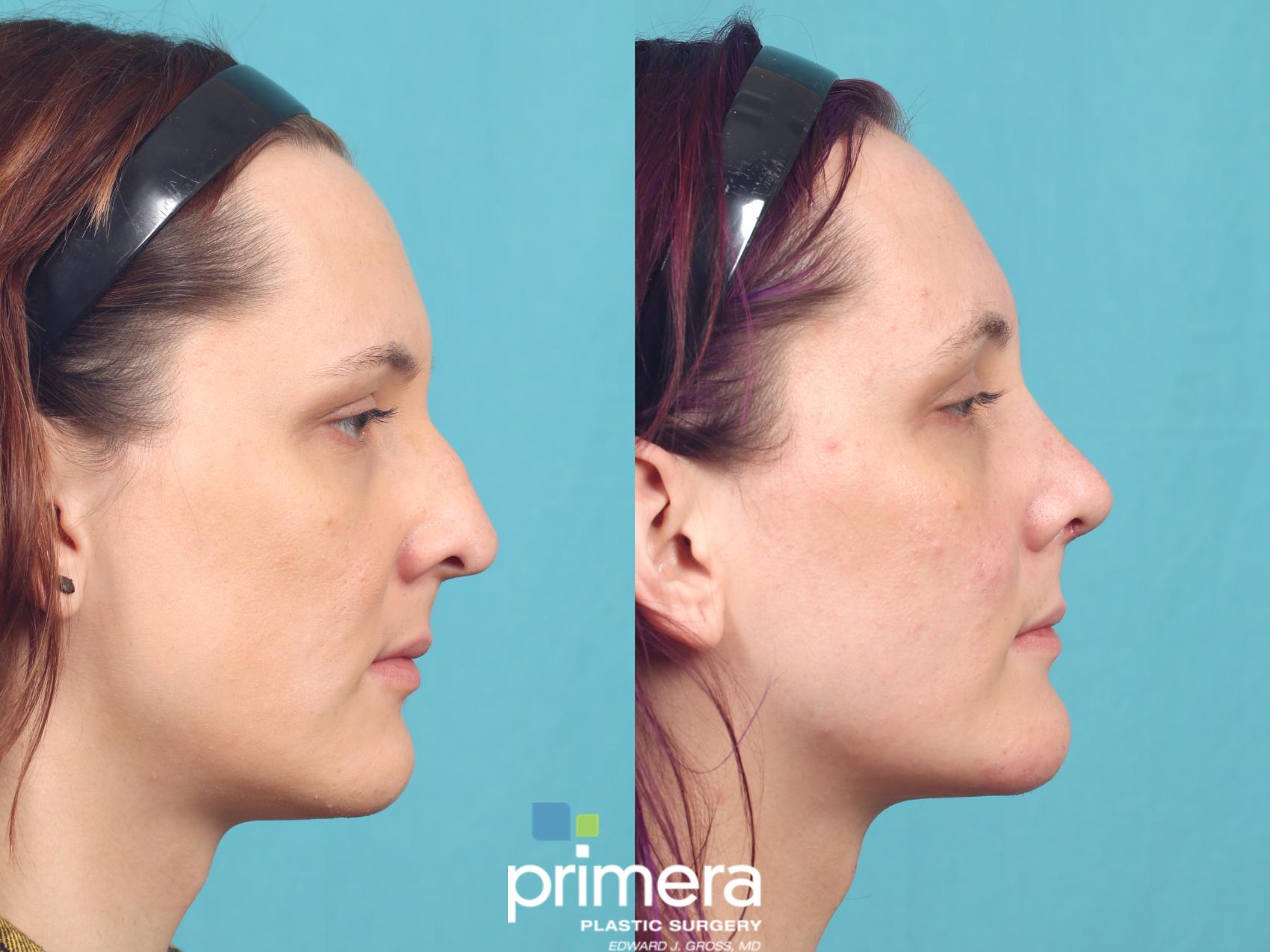 Before & After Rhinoplasty Case 992 Right Side View in Orlando, Florida