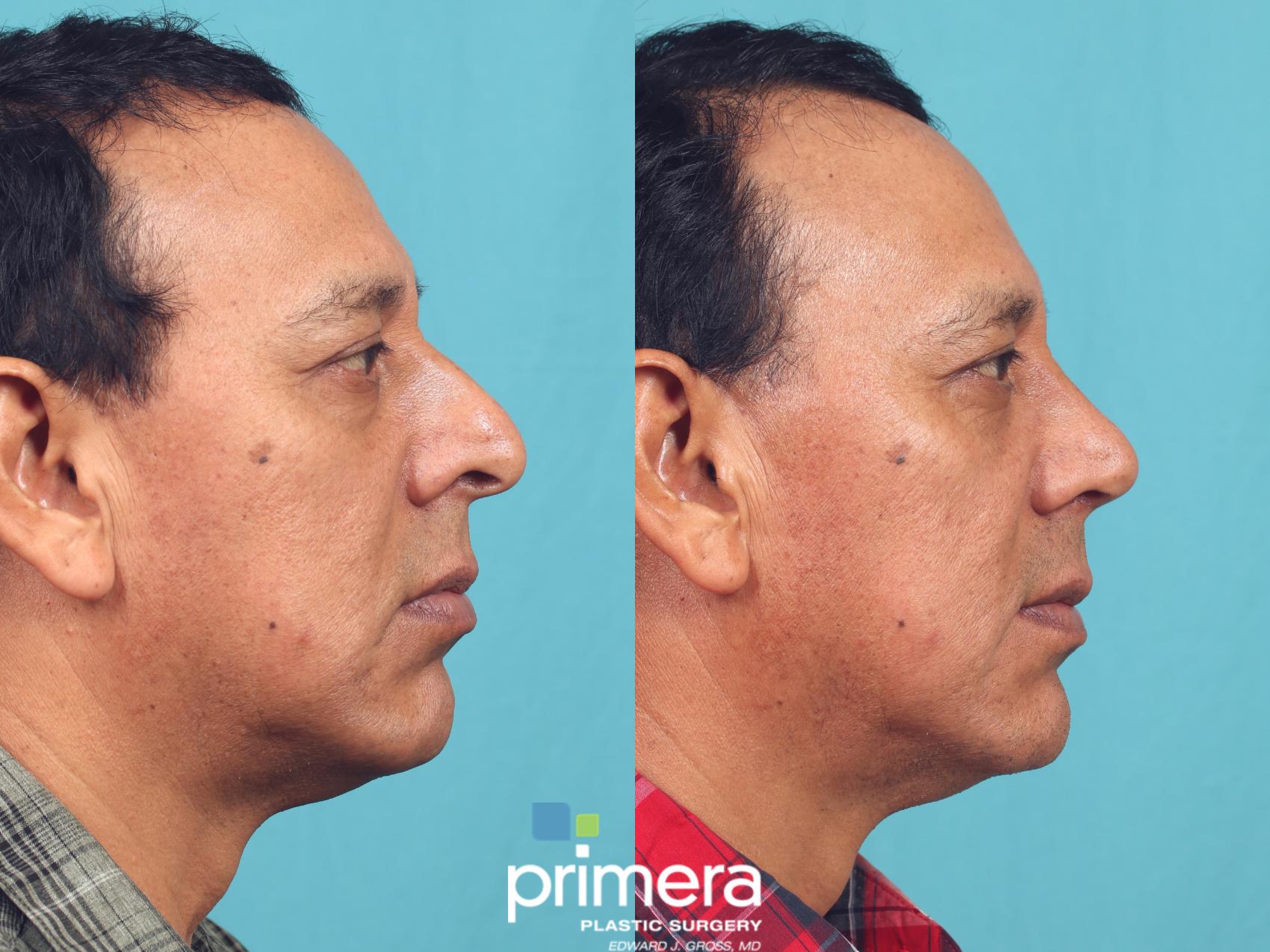 Before & After Rhinoplasty Case 993 Right Side View in Orlando, Florida