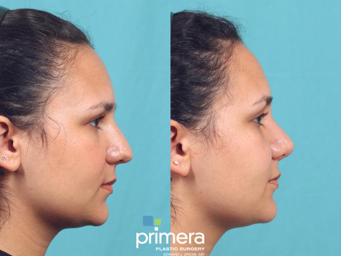 Before & After Rhinoplasty Case 994 Right Side View in Orlando, Florida