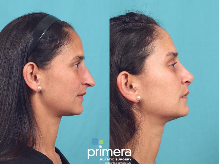 Before & After Rhinoplasty Case 997 Left Side View in Orlando, Winter Park & Tampa, Florida