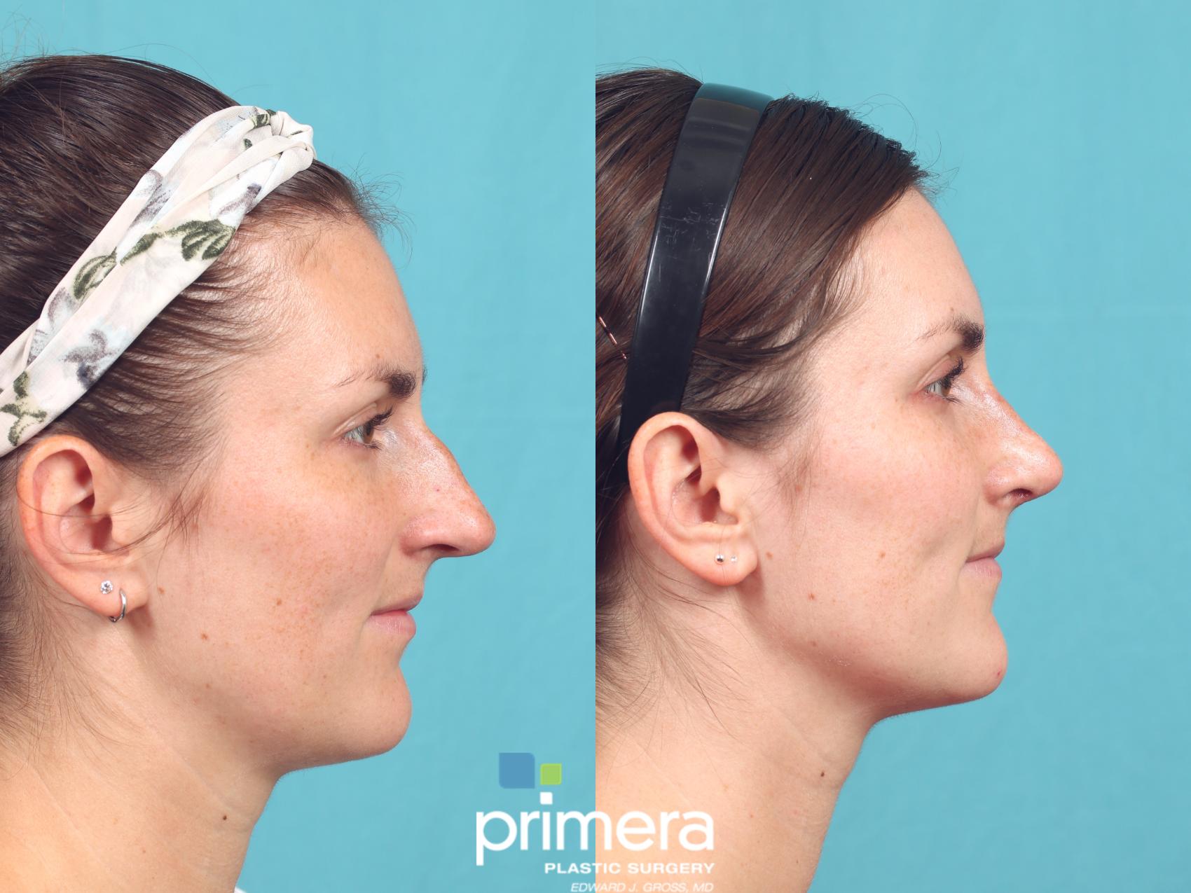 Before & After Rhinoplasty Case 998 Left Side View in Orlando, Winter Park & Tampa, Florida