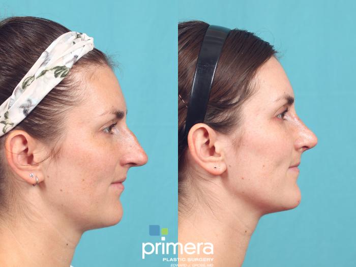 Before & After Rhinoplasty Case 998 Left Side View in Orlando, Winter Park & Tampa, Florida