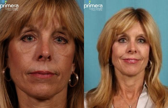 Before & After Sculptra® Case 273 view-1 View in Orlando, Florida