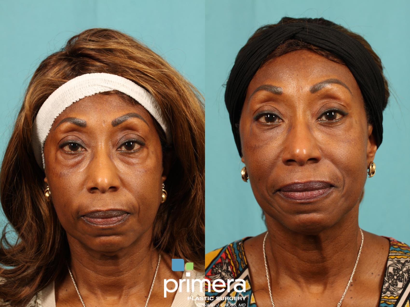 Before & After Sculptra® Case 607 Front View in Orlando, Florida