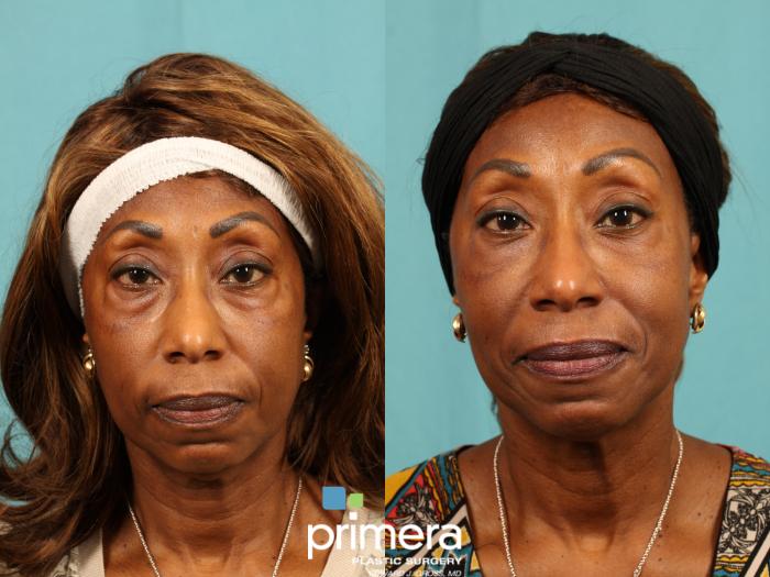 Before & After BOTOX® Cosmetic Case 607 Front View in Orlando, Florida