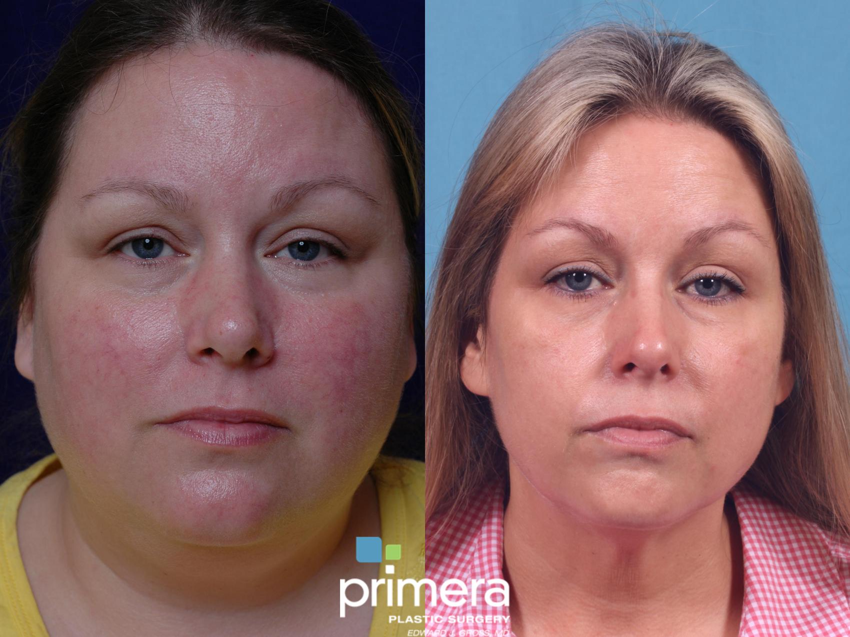 Skin Discoloration Treatment Before After Photo Gallery Orlando Florida Primera Plastic Surgery