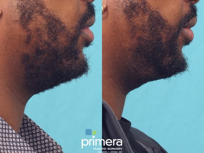 Before & After Submentoplasty (Chin Tuck) Case 1051 Right Side View in Orlando, Winter Park & Tampa, Florida
