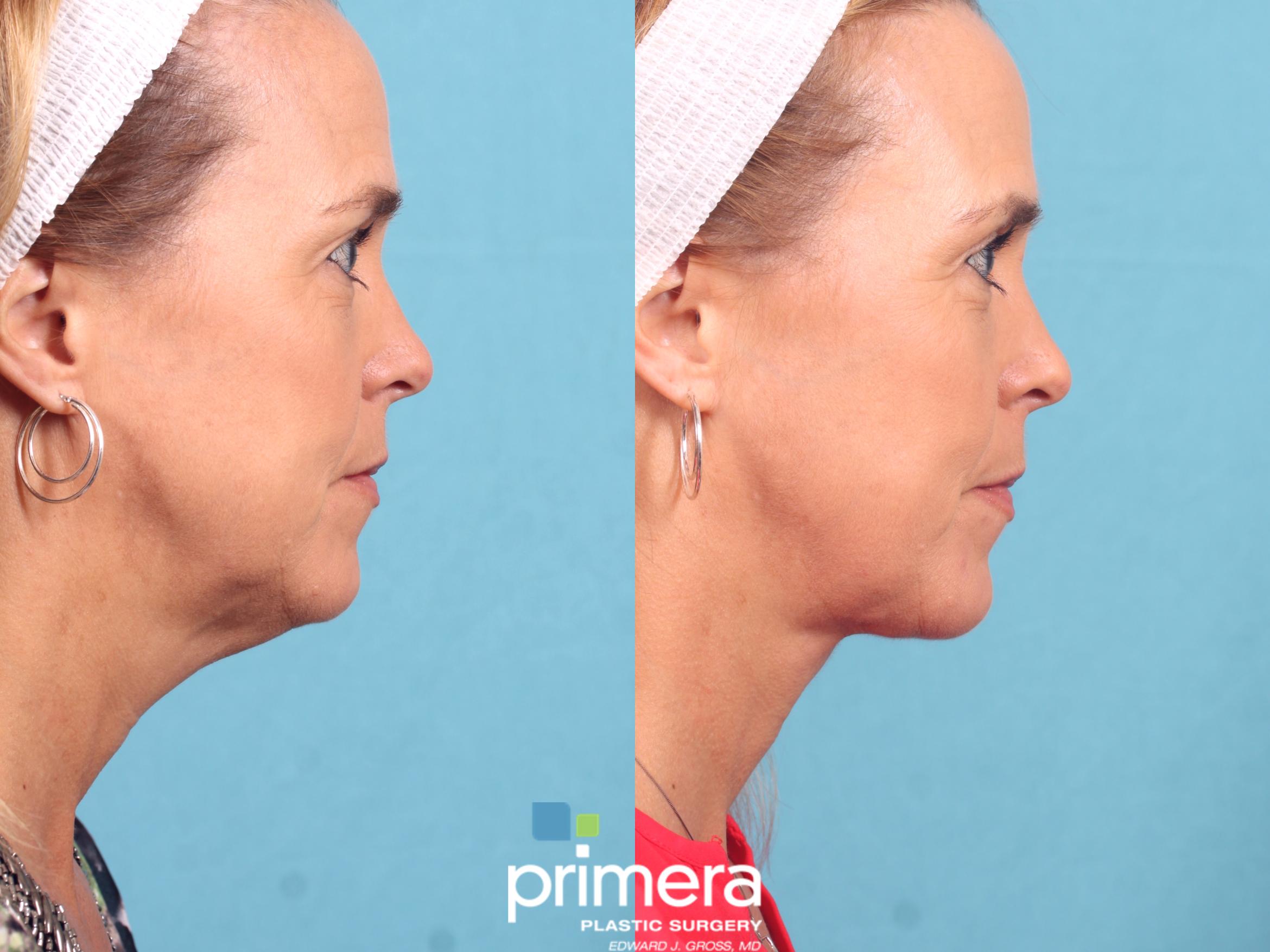 chin tuck exercise before and after