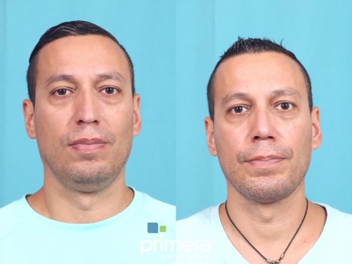 Before & After Submentoplasty (Chin Tuck) Case 720 Front View in Orlando, Florida