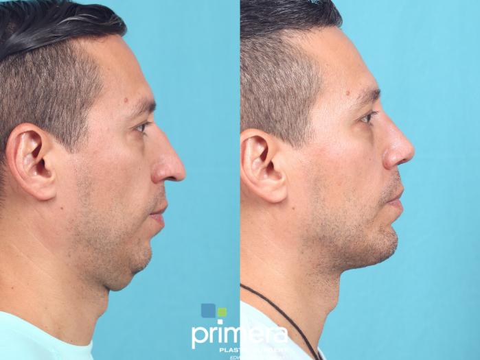 Before & After Submentoplasty (Chin Tuck) Case 720 Right Side View in Orlando, Florida