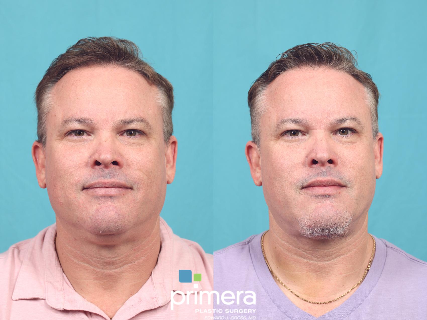 Before & After Submentoplasty (Chin Tuck) Case 959 Front View in Orlando, Florida