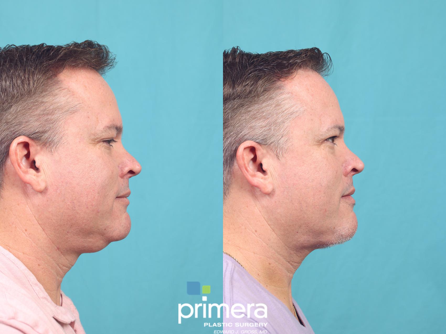 Before & After Submentoplasty (Chin Tuck) Case 959 Right Side View in Orlando, Florida