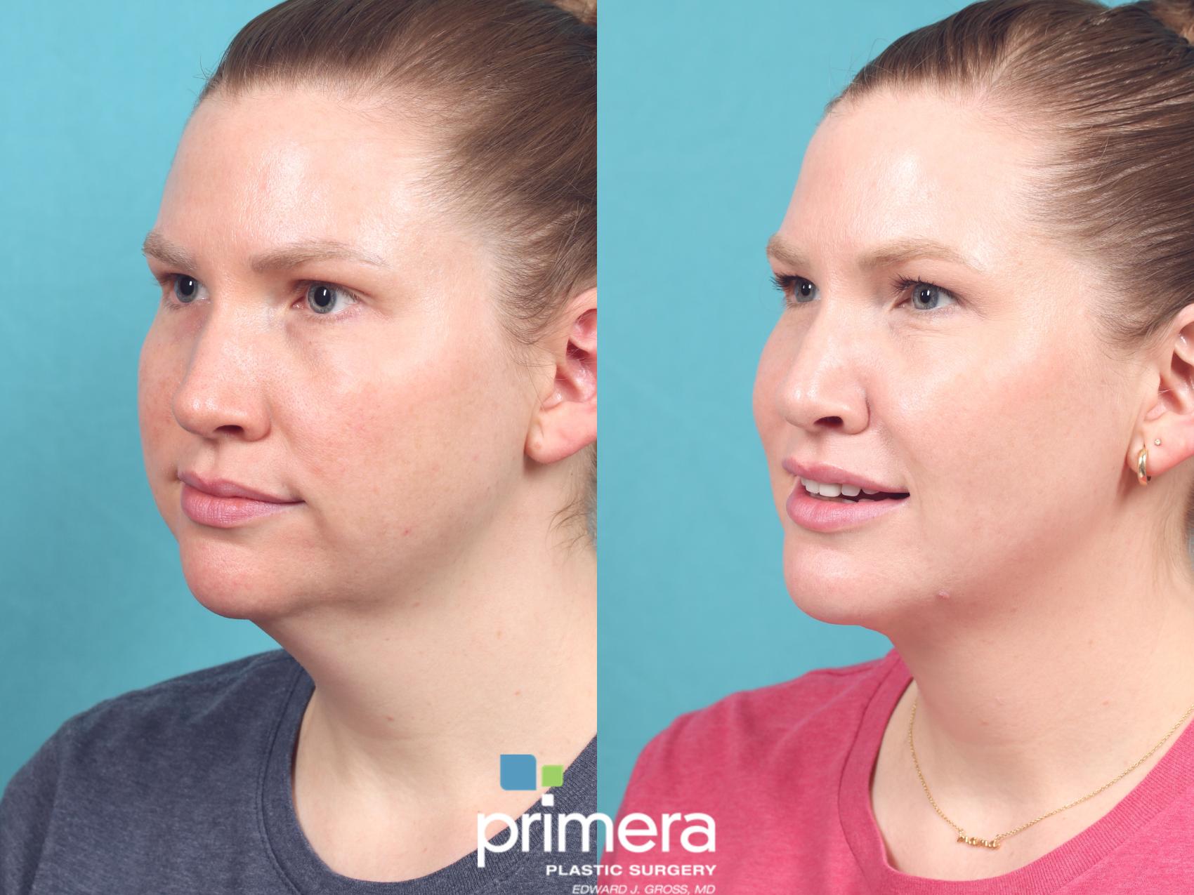 Before & After Neck & Face Liposuction Case 979 Left Oblique View in Orlando, Florida