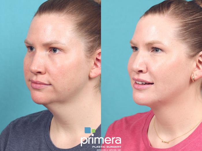 Before & After Buccal Fat Removal Case 979 Left Oblique View in Orlando, Florida