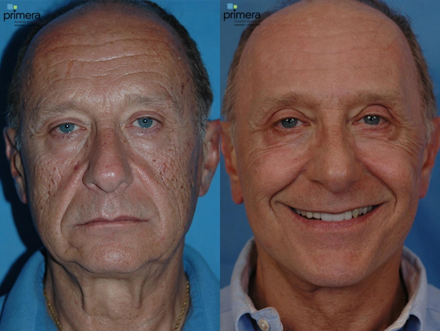 Facelift Before After Photo Gallery Orlando Florida Primera Plastic Surgery