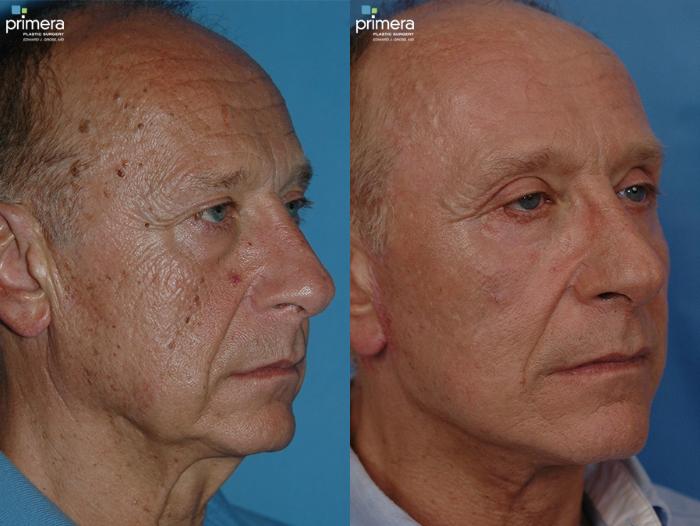 Before & After Laser Skin Resurfacing (DOT CO2) Case 24 view-2 View in Orlando, Florida