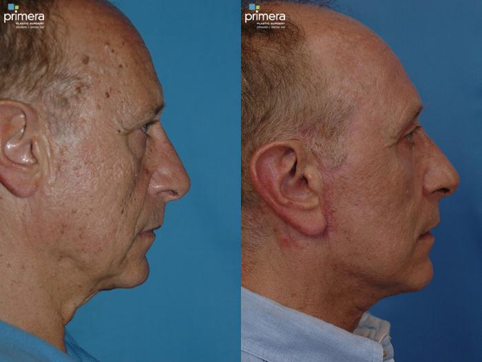 Before & After Facelift Case 24 view-3 View in Orlando, Florida