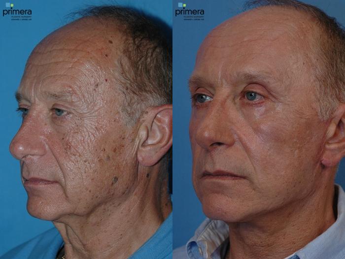 Before & After Laser Skin Resurfacing (DOT CO2) Case 24 view-4 View in Orlando, Florida