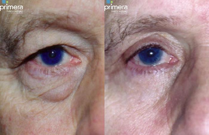Before & After Blepharoplasty Case 266 view-1 View in Orlando, Florida