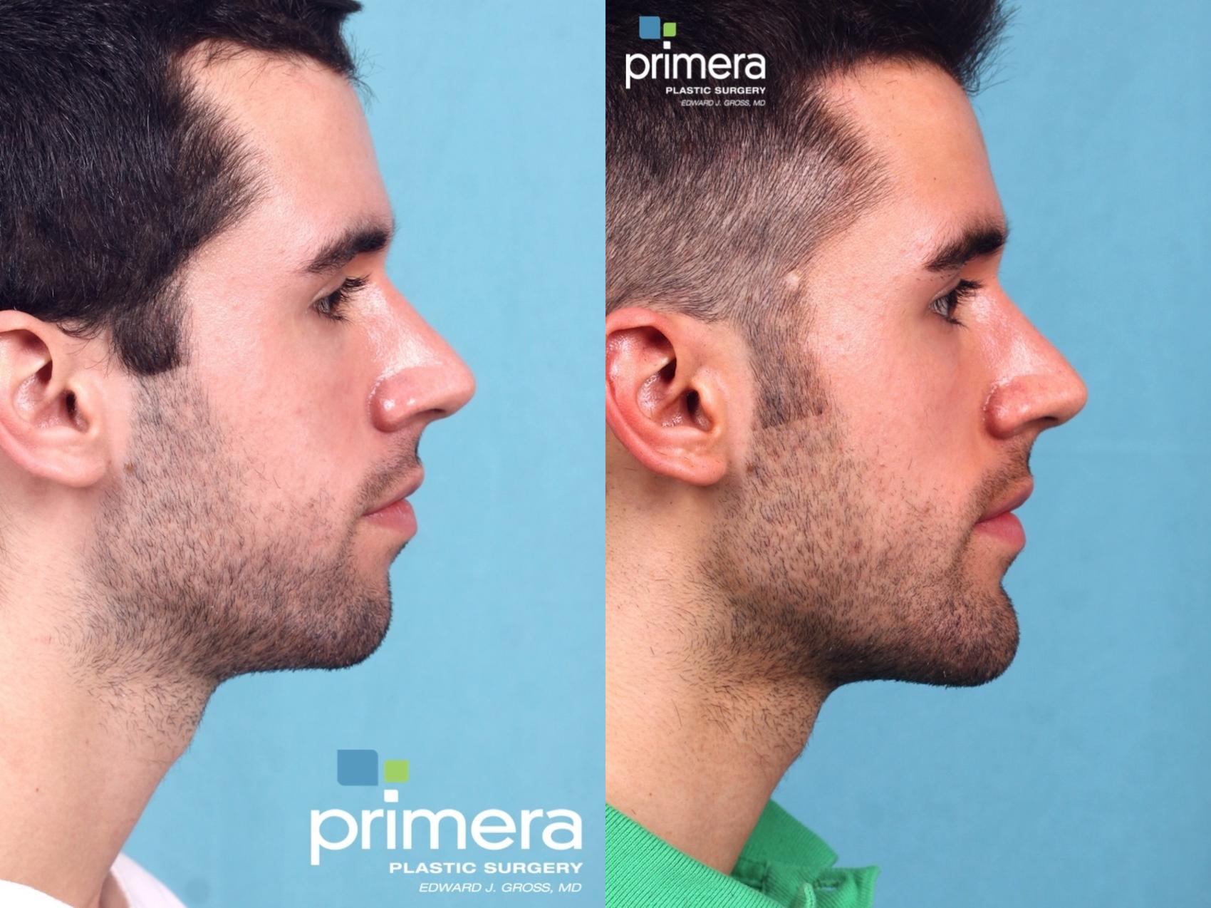 male jaw implant before and after