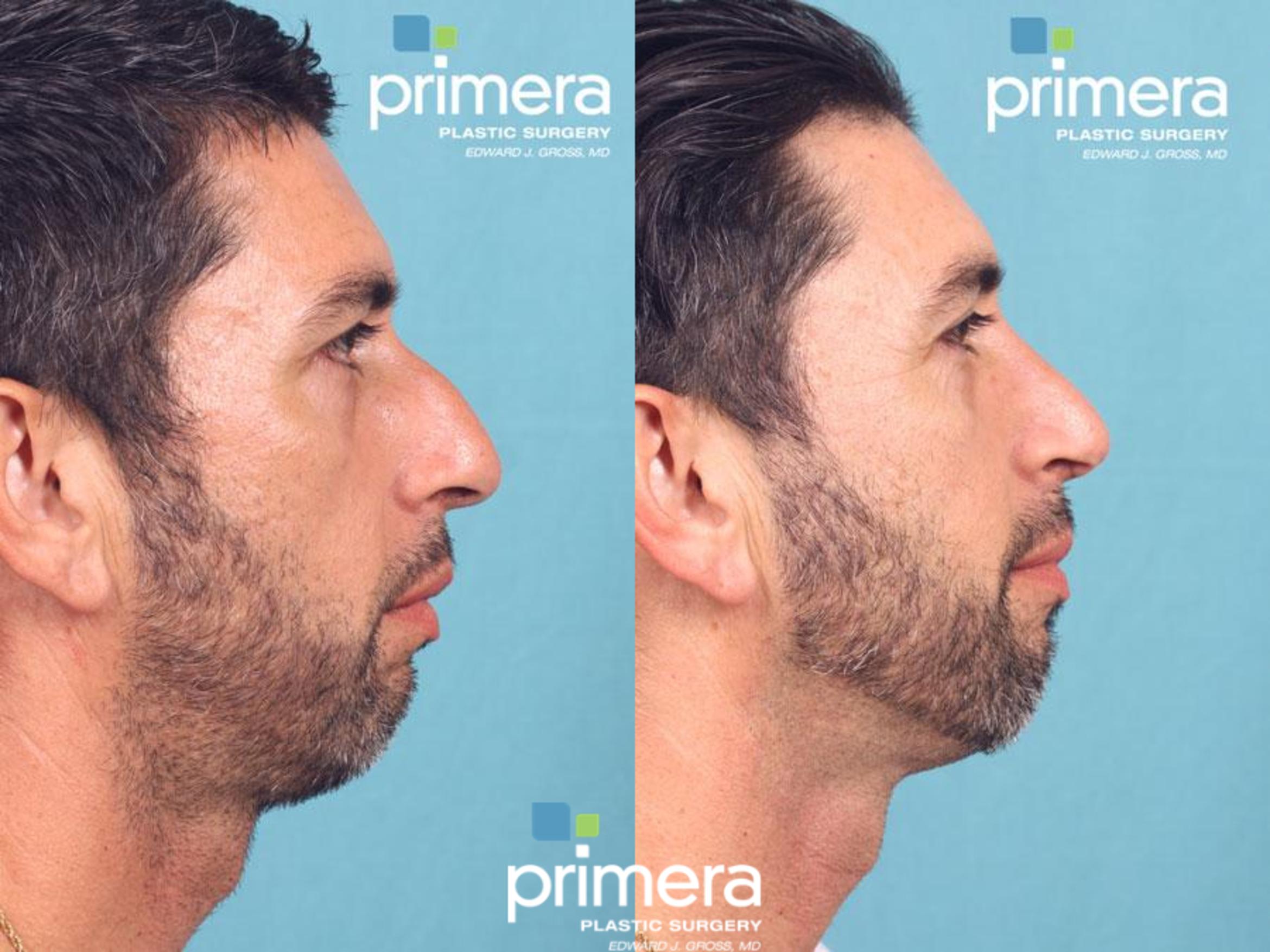 Surgery For Men Before After Photos Patient 531 Orlando Florida Primera Plastic Surgery